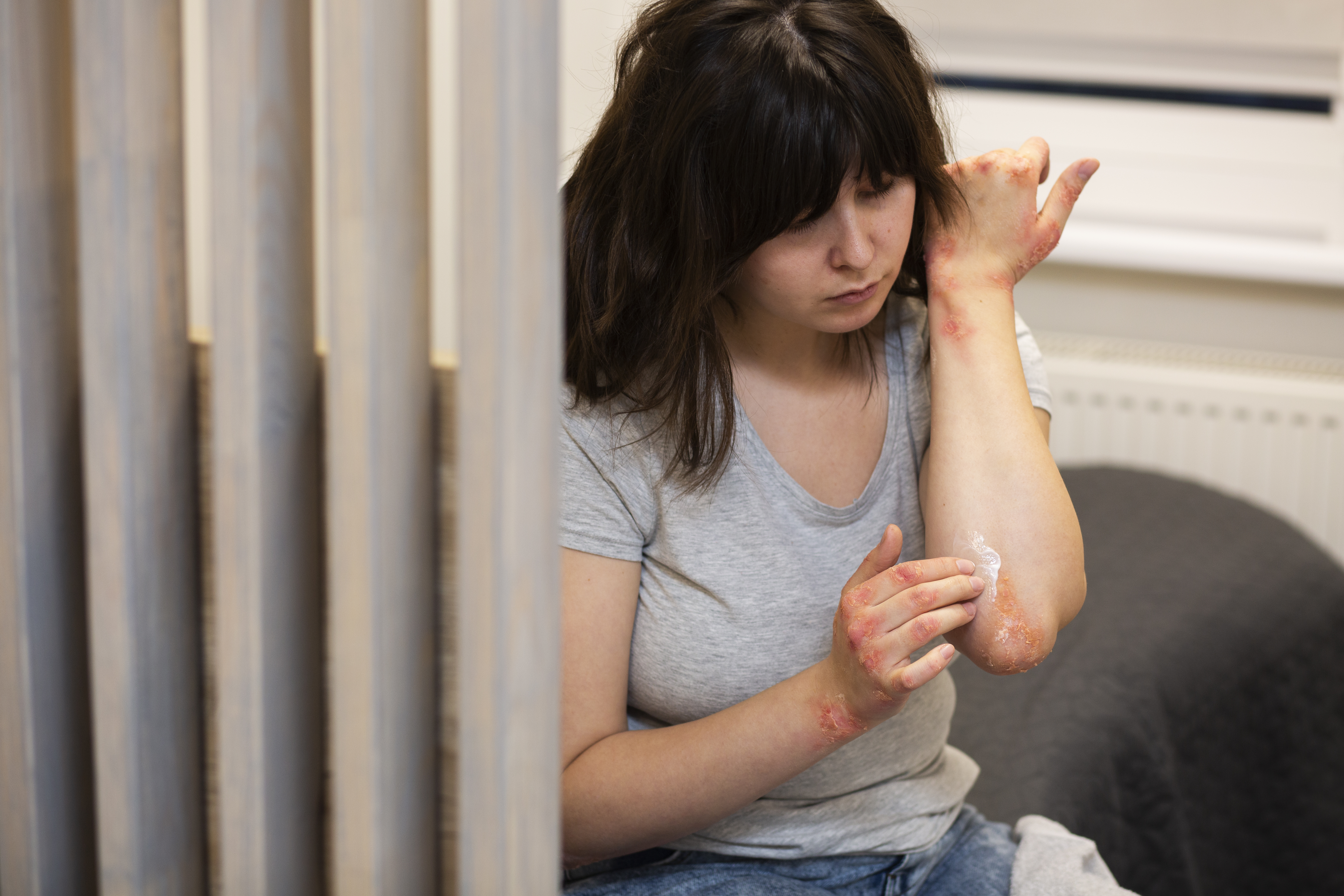 Γυναίκα ασθενής με ψωρίαση στα χέρια